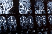 Neurologia - Dr. Marcus Vitor Oliveira - 04